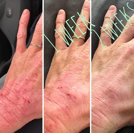 Eczema Honey's Before and After
