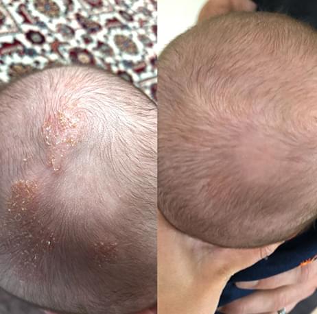 Eczema Honey's Before and After
