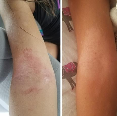 Eczema Honey's Before and After