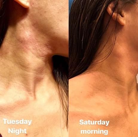 Eczema Honey's Before and After